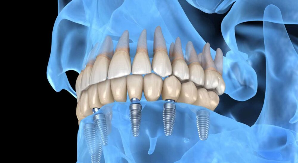 Το Invisalign είναι μια επιλογή για το ίσιωμα των δοντιών