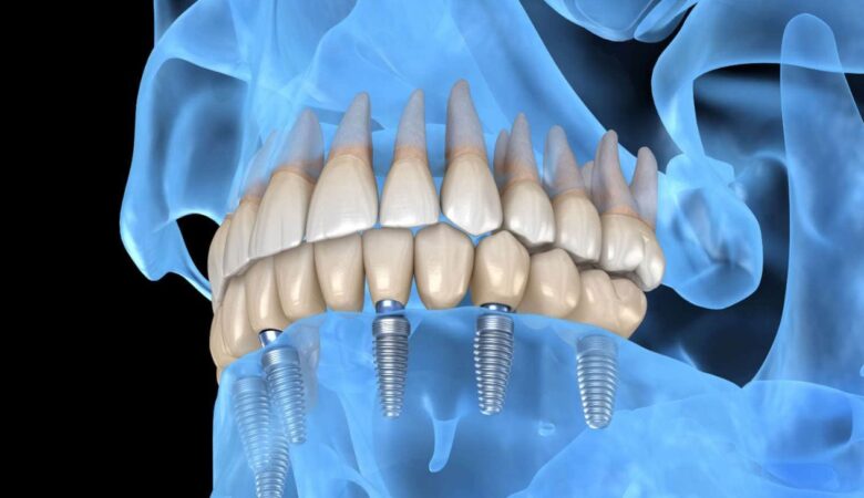 Το Invisalign είναι μια επιλογή για το ίσιωμα των δοντιών